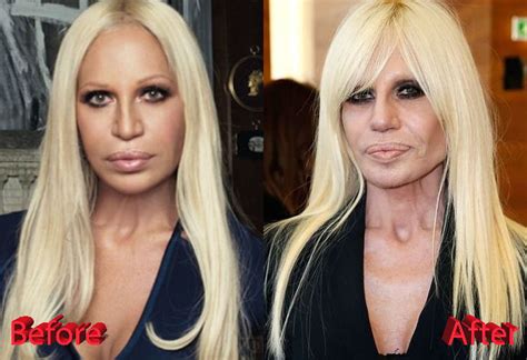 donatella versace dopo|donatella versace before and after surgery.